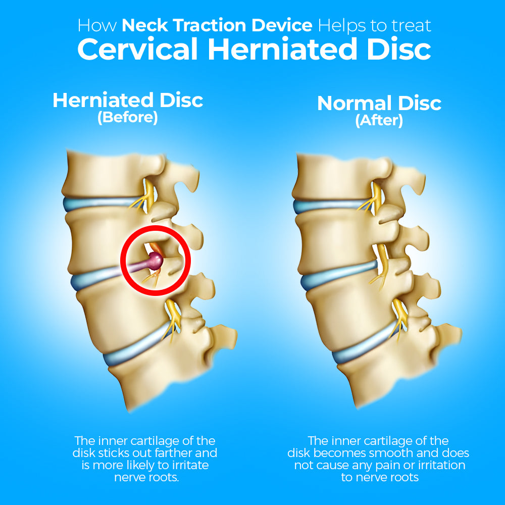 Fisher Traction Neck Traction Device | Fisher Traction